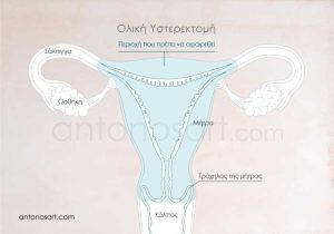 medical illustration hysterectomy antonosart